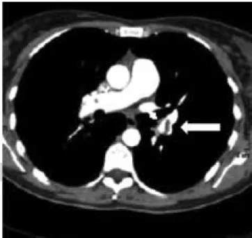 Figura 2. Trombo intravascular, se observa una lesión hipo-
