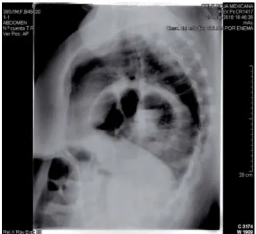 Figura 1. Radiografía de tele de tórax. Obsérvese imagen de 