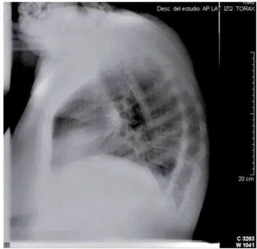 Figura 11. Radiografía de tórax lateral izquierda de control.