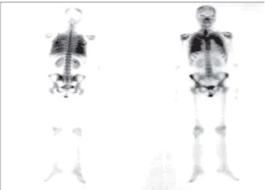 Figura 5. Gammagrama óseo con
