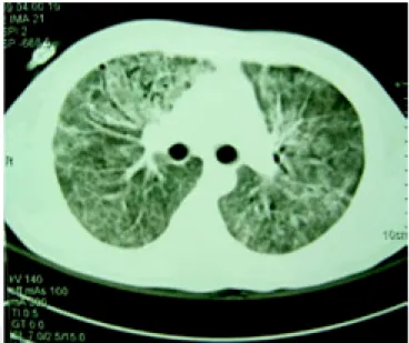 Figura 1. Tomografía de tórax de alta resolución en su venta-