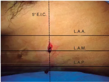 Figura 4. Sitio de colocación de la sonda endopleural: incisión 