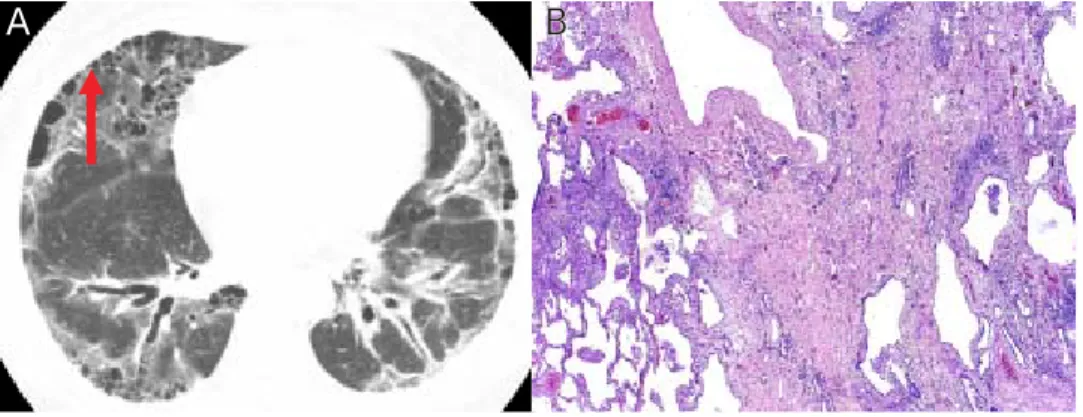 Figura 6. Escleroderma y patrón UIP.