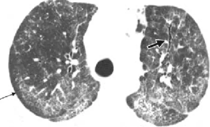 Figura 8. TCAR Escleroderma y patrón NSIP.  Se aprecian