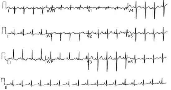 Figura 6. ECG de mujer de 56 años
