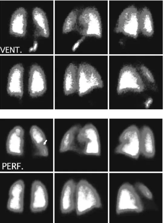 Figura 7. Gammagrama pulmonar.