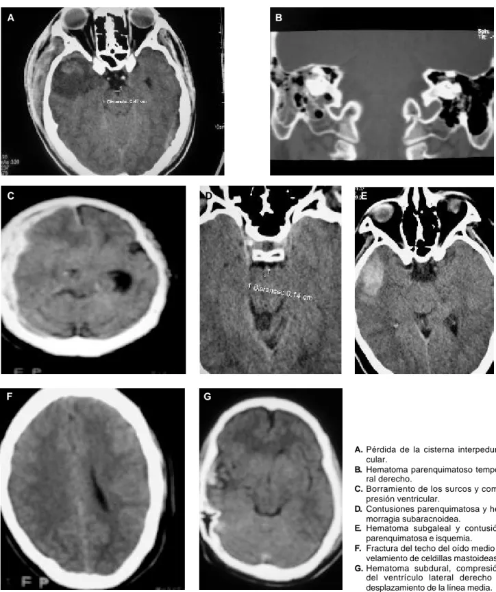 Figura 14. Imágenes de tomografía computada que muestran los hallazgos encontrados en los pacientes de trauma.