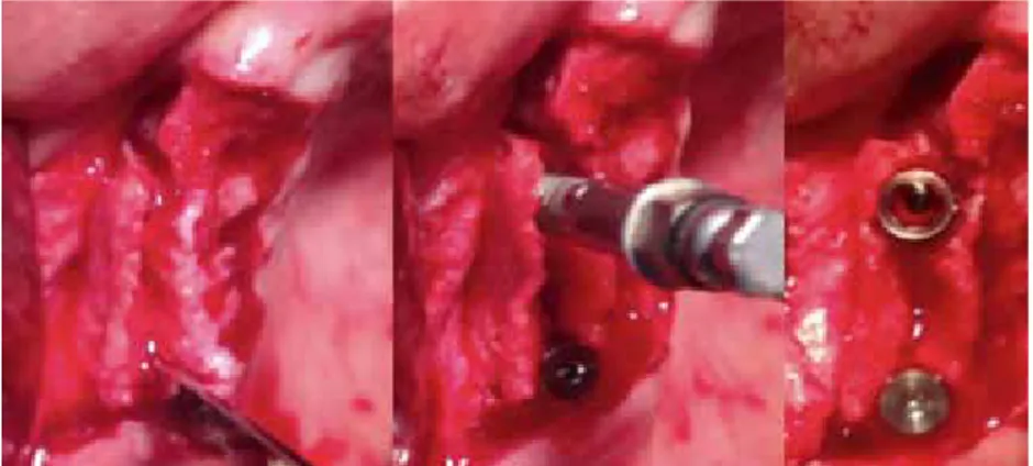 Figura 2: Proceso del Rigde Split con cincel e instalación de implantes.