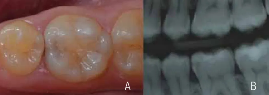 Figure 2. a: Initial aspect: presence of occlusal-mesial (OM) lesion of the mandibular left first molar