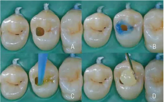 Figure 3. a: Aspect after carious tissue removal. b. Selective conditioning of enamel