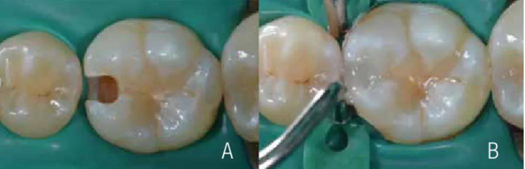 Figure 5. a. Class II preparation after removal of carious tissue. b. Application of a coating layer of resin.