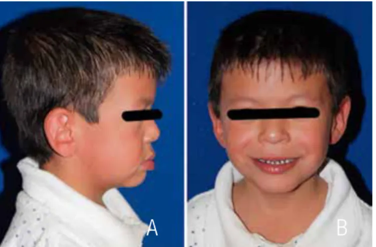 Figure 1. Extraoral examination. (A) Profile view. (B) Frontal view.