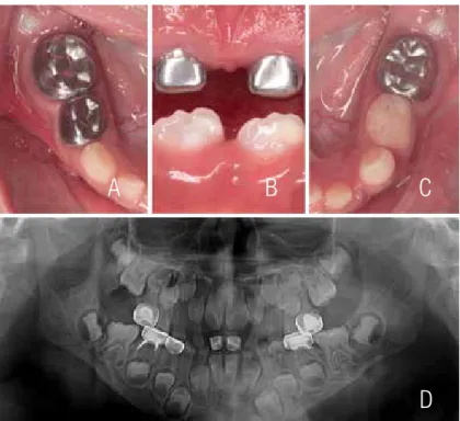 Figure 5. Follow-up of newly erupted permanent teeth with diffuse opacities of  enamel