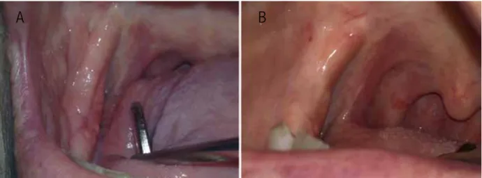 Figura 4. A) Control a los 15 días de la biopsia en mandíbula. B) Control a los 15 meses donde se observa libre de lesiones.