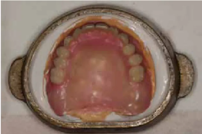 Fig. 1. Flasking of the denture.