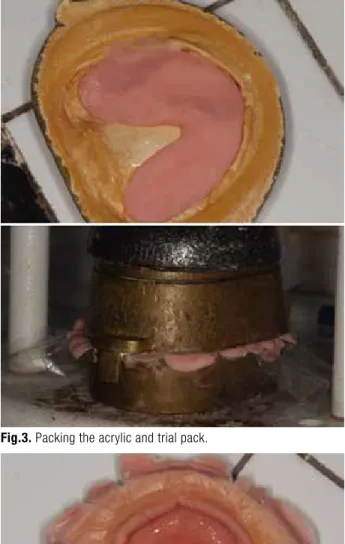 Fig. 6. Covering the print with a segment of the acrylic flash.