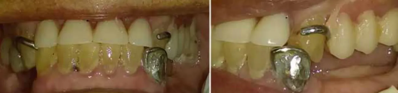 Fig. 2. Plano oclusal inicial