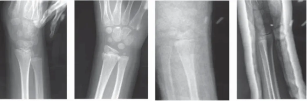 Figura 3. A) Masculino de siete años que  posterior a una caída presenta lesión SH II en 