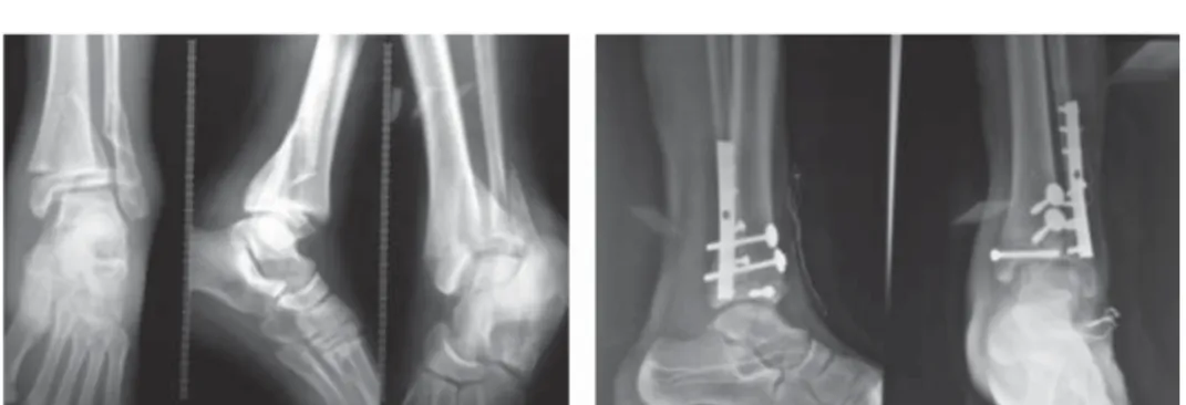 Figura 5. A) Proyecciones radiográfi cas del  tobillo de un paciente masculino de 11 años  donde se observa una fractura triplanar