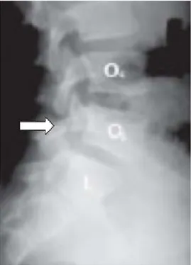 Figura 2. Espondilólisis L5.