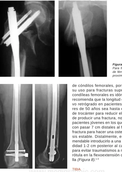 Figura 6. PFN.