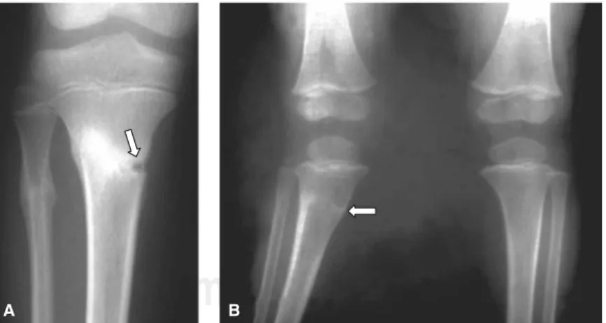 Figura 2. Tejido interpuesto. A. Las radiografías tomadas 6 semanas después de la fractura