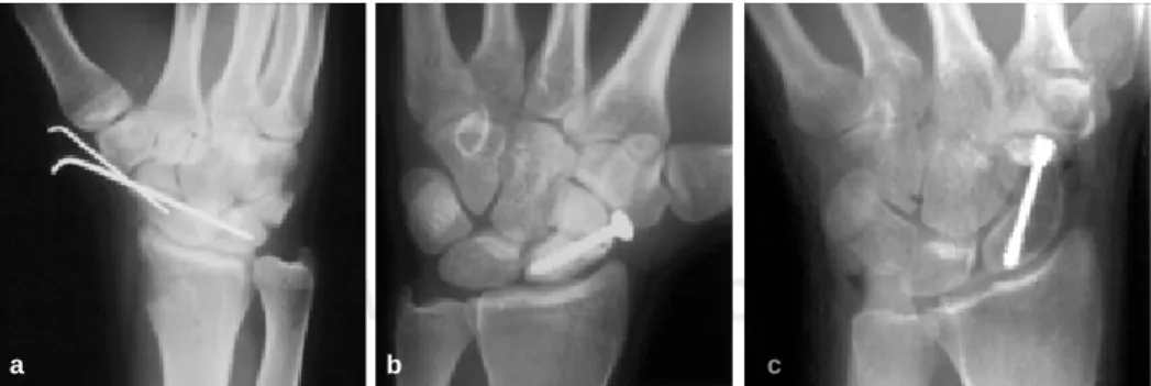 Figura 1. Diferentes métodos de osteosíntesis del escafoides: a: Clavos Kirschner, b: Tornillo AO; c: Tornillo de Herbert.