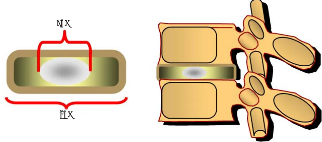 Figura 3. La carga axial se distribuye en el disco intervertebral 75% en el núcleo pulposo y 25%