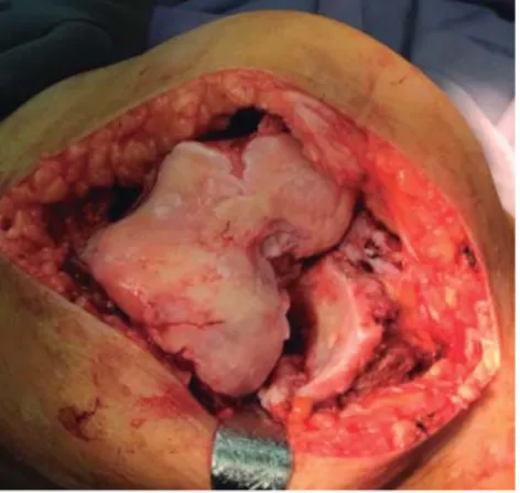 Figura 5. Rodilla con deformidad en valgo, 