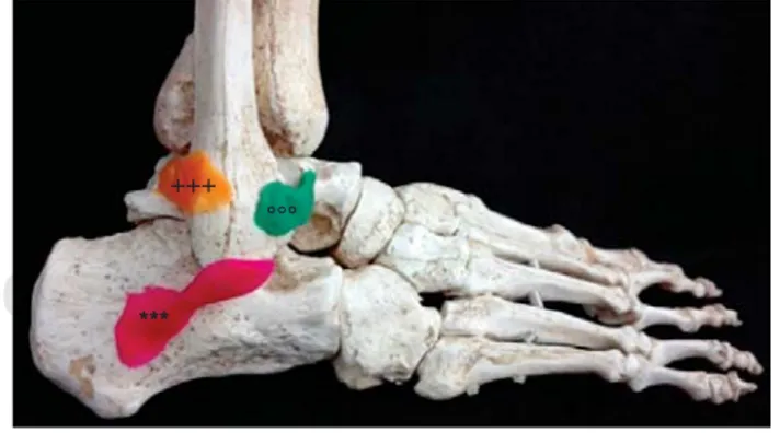 Figura 1. Disposición de los fascículos del complejo  ligamentario lateral del tobillo