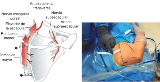 Figura 8. Técnica quirúrgica de la artroscopia de escápula.