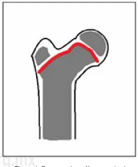 Figura 1. Esquema de un fémur proximal 