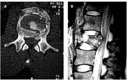 Figura 2A. Imagen axial de una fractura tipo B sin lesión neurológica en la que se observa el 