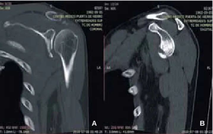 Figura 3. Tomografía  computada con corte  coronal (A) y sagital (B).