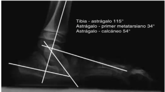 Figura 4. Radiografía lateral de pie con astrágalo  vertical congénito.