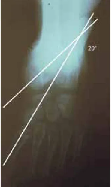 Figura 5. Radiografía  antero-posterior, medición del 