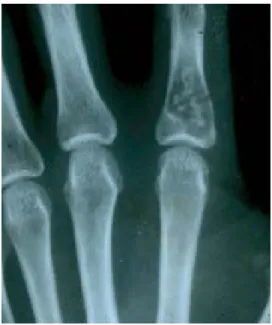Figura 2. Falange dedo índice con un condroma (Encondroma) en su base, el diagnóstico se