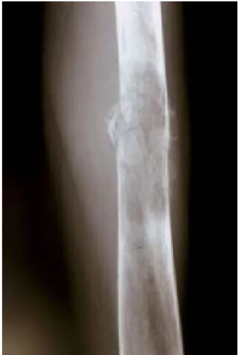 Figura 7. Fractura del tercio medio del fémur sobre osteosarcoma paraosteal.