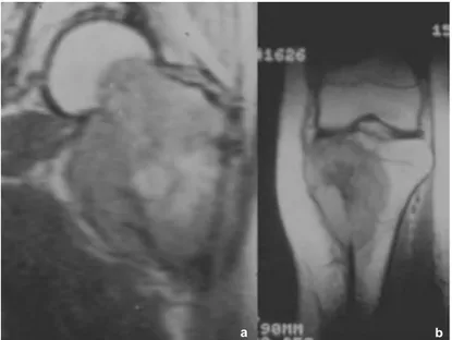 Figura 8. a. IRM por fibrosarcoma de fémur. b. IRM por osteosarcoma tibia.