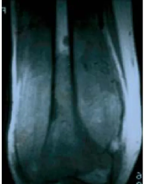 Cuadro III.  Escala para prevenir una fractura sobre la zona de escisión de un tumor óseo.