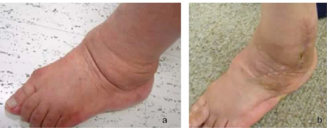 Figura 11. a) Pie plano valgo pronado preoperatorio, b) postoperatorio.
