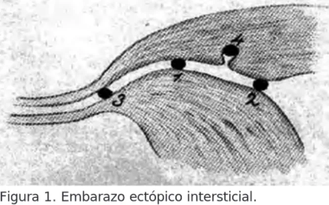 Figura 1. Embarazo ectópico intersticial. 