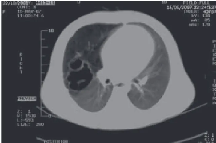 Figura 1. TC torácica de múltiples formaciones quísticas en pulmón 