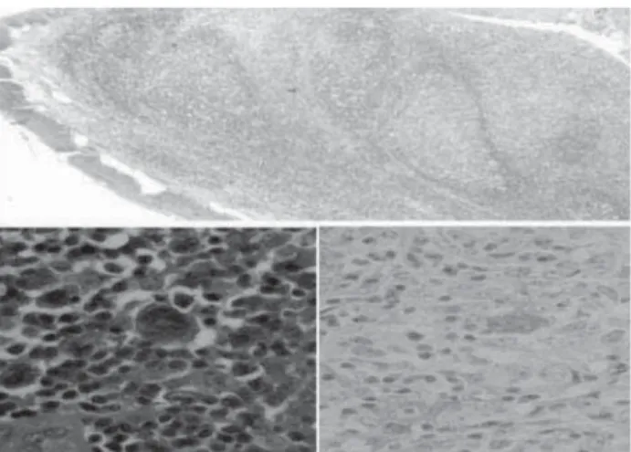 Figura 9. Linfoma en amígdala palatina no Hodgkin difuso de  células grandes CD 20 positivo (H-E y PAP).