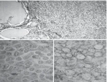 Figura 12. Linfoma no Hodgkin difuso de células grandes en tiroides  CD20 positivo (H-E y PAP).