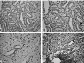 Figura 1. Expresión del VEGF-A y KDR en células epiteliales  neoplásicas. (a) VEGF-A, carcinoma papailar con extensión  extrati-roidea, mayor de 10 mm, positivo (++)