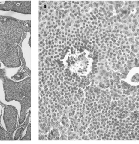 Figura 1. (A) Tumor neuroendocrino con patrón insular. (B) Células homogéneas sin atipia nuclear.