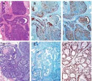 Figure 3. Distinguishing usual hyperplasia from atypical ductal hy- hy-perplasia and ductal carcinoma in situ is based on identification of a  clonal cell process, as recognized by uniformity of cytomorphology  and immunophenotype