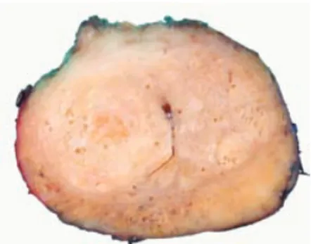 Figura 6. Aspecto macroscópico del cáncer 