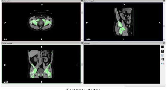 Figura  20.  Tomografías  computacionales  utilizadas  para  la  reconstrucción  de  la  proximal superior del fémur